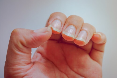 Brittle-Fingernails
