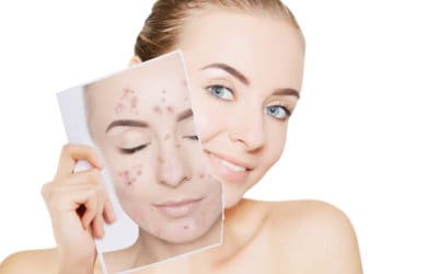 Face Masks Causing Acne? Learn How Facials Can Help Your Skin