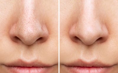 Can A Facial Remove Blackheads?