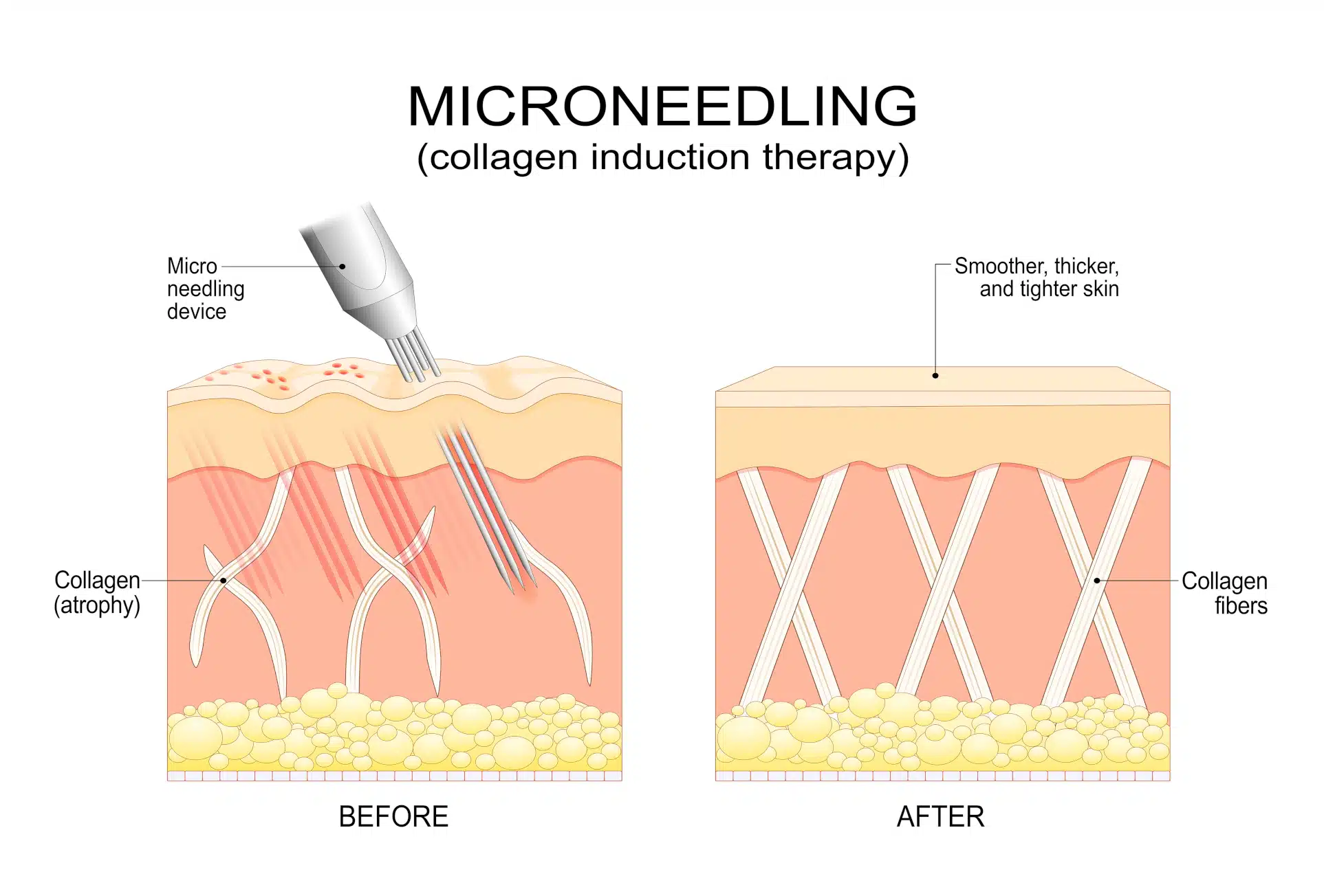 microneedling_graphic A graphic explaining how microneedlings works (also explained in text below)