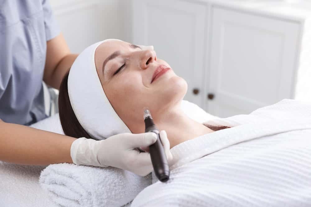 Microneedling for Acne Scars: What to Really Expect